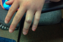 Katherine's Broken RIng Finger Before Cast