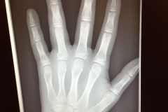 Another Xray of Katherine's Ring Finger